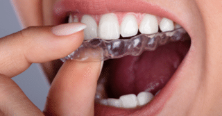 שיפור עבור השיניים
